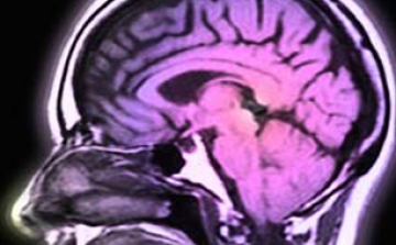 Hogyan védekezik az agy a stroke okozta károsodás ellen?